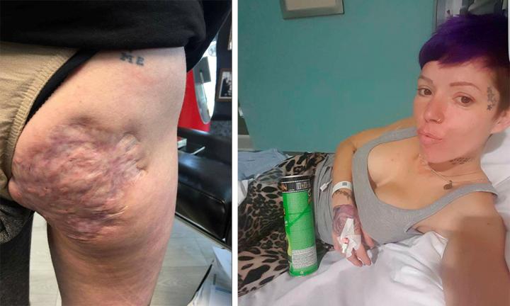 Mum-of-six finds unique way to hide her Crohn's disease scars