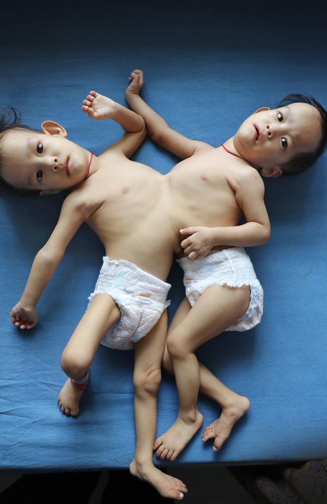 Nima and Dawa were flown to Australia to have lifesaving surgery, thanks to the Children First Foundation and the Royal Children's Hospital. Picture: Alex Coppel