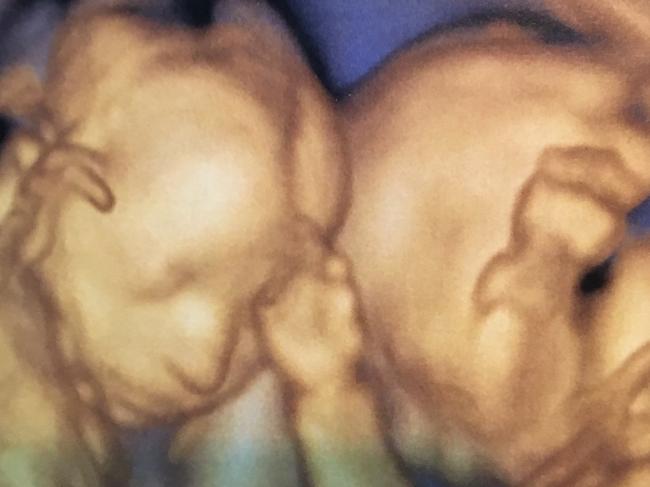 A scan of the twins at six months.