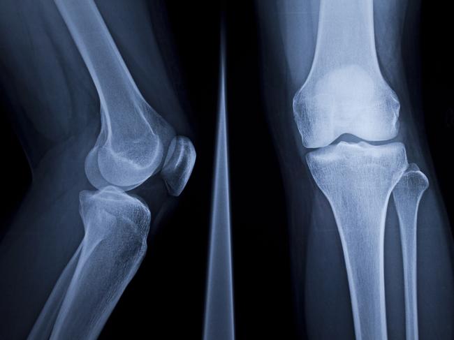 X-Ray of human knee  Picture: istock