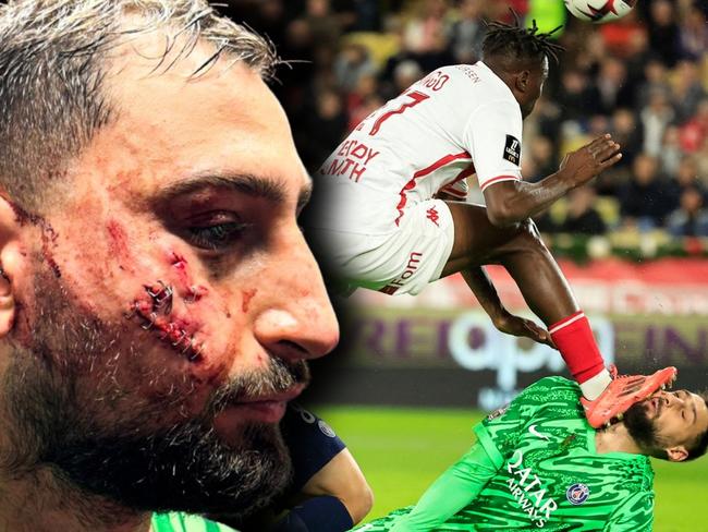 Donnarumma gruesome facial injury soccer