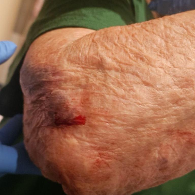 One aged care resident suffered injuries after falling getting on a bus without help. Picture: Supplied