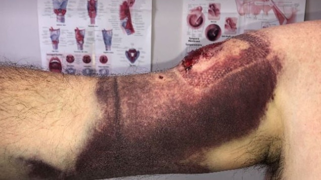 Zeus, a declared dangerous dog, left Malcolm Thorp with this horrific injury. Picture: Supplied