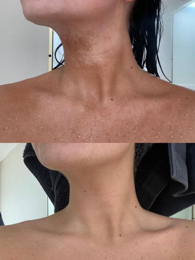 From fake tan removal to smoother skin, fans of My Glow 2 have shared their drastic transformations on social media. Picture: Instagram.