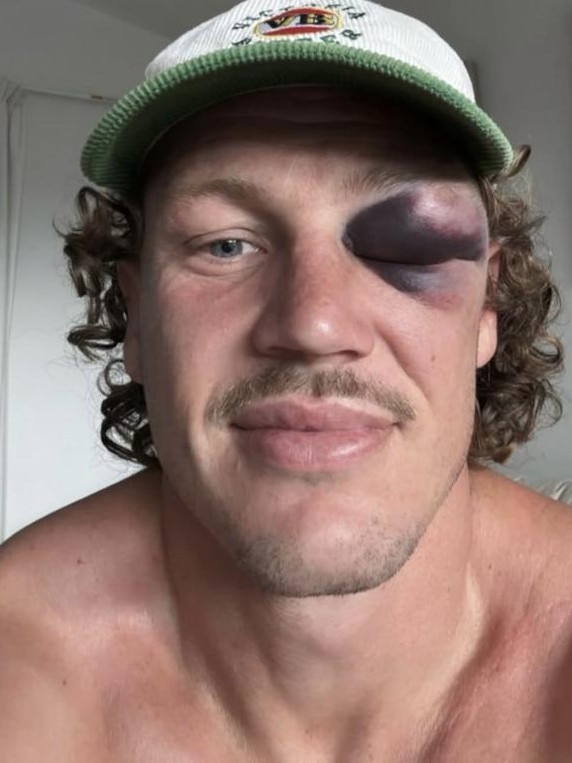 Quite the shiner for Kurt Mann. Pic: Instagram