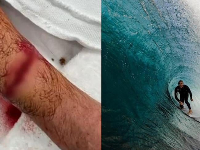 The 30-year-old had to have multiple shark teeth removed from his arm. Picture: Supplied