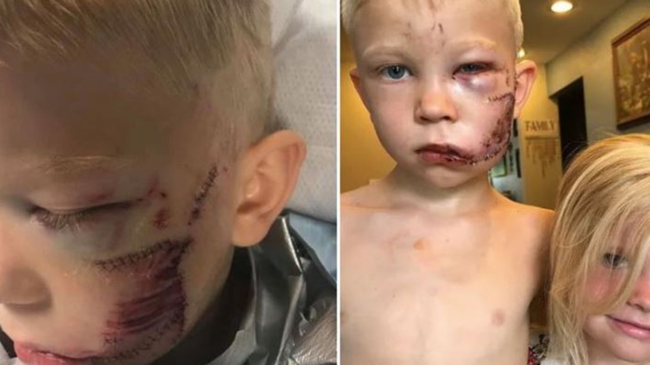 Bridger Walker, 6, suffered serious facial injuries after protecting his little sister from a vicious dog in the USA.