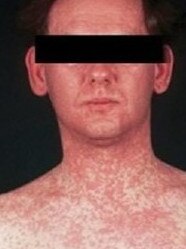 A typical measles rash. Picture: Victoria Department of Health