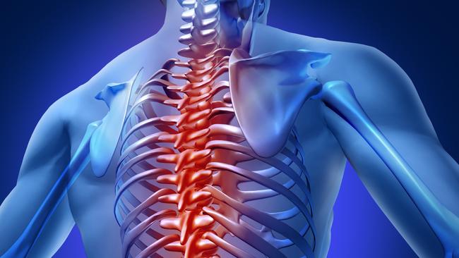 A Melbourne-developed stem cell treatment is helping regenerate spinal discs and reducing back pain.