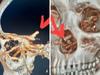 Wild cause of man’s 5-month headache