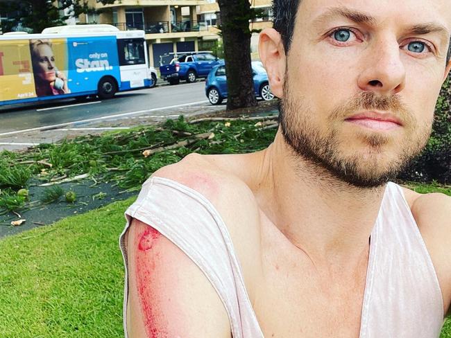 Alex Laverty, of Queenscliff, received severe bruising and abrasions when he was hit by large branches and pine cones that fell from a Norfolk Island pine tree on the beachfront at Manly, along North Steyne. Picture: Alex Laverty