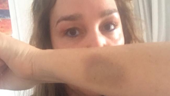 Kate Langbroek with the bruise she sustained after she was attacked at her St Kilda home on March 2. Picture: Twitter/ @katelangbroek