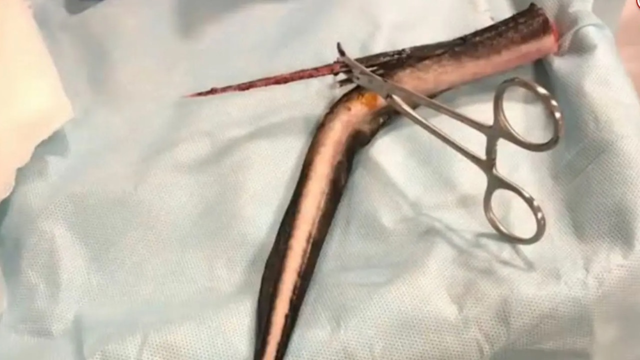 A woman trying to enjoy a relaxing afternoon in the ocean off Florida was impaled by a poisonous stingray whose barb came centimetres away from piercing her lungs.