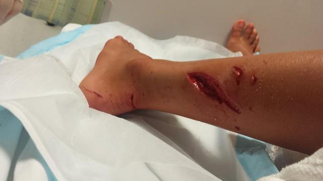 Kirra-belle Olsson after she was attacked by a shark at Avoca Beach. Picture: Facebook