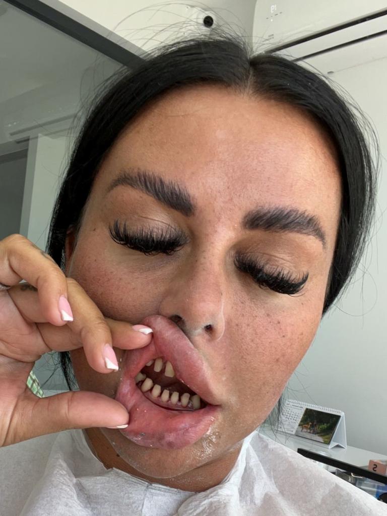 Jade Tushingham after having her teeth filed down. Picture: SWNS