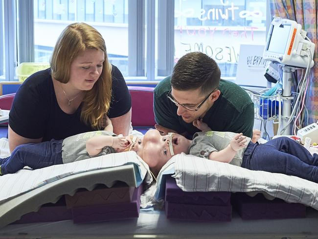 Conjoined twins separated successfully at 10 months old | news.com.au ...