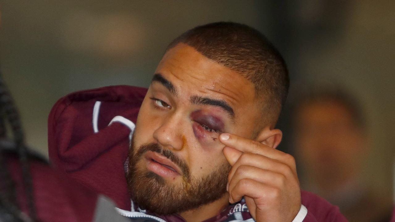 Dylan Walker sports the injured eye after Curtis Scott’s flurry of punches.