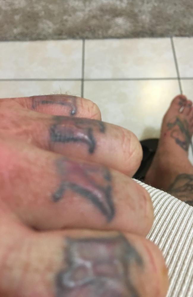 Tattoo removal gone wrong: 'I got a tattoo and ended up with third degree  burns'  — Australia's leading news site