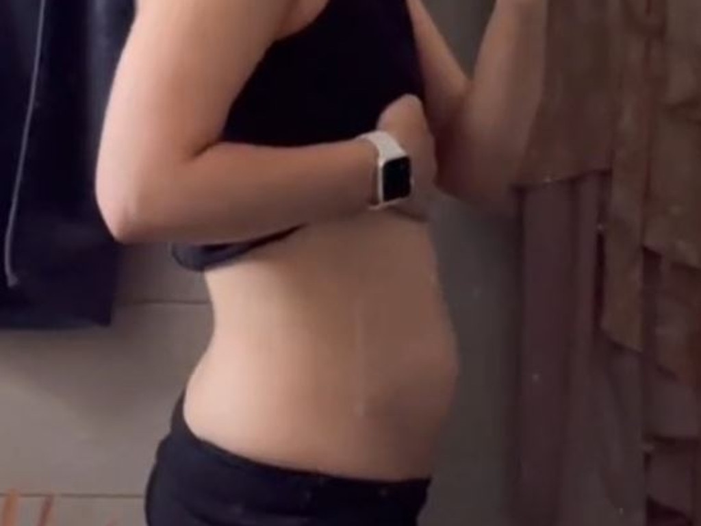 Bloating is a common symptom of endometriosis. Picture: Chloe Jackson/TikTok