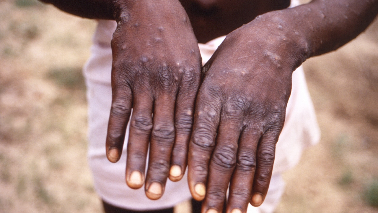 Australia secured 450,000 monkeypox vaccines