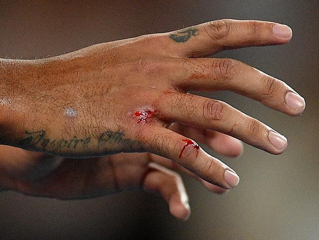 Kyrgios’ bleeding hand was at the centre of his 2020 Australia Open blow up with chair umpire Renaud Lichtenstein. Picture: AAP