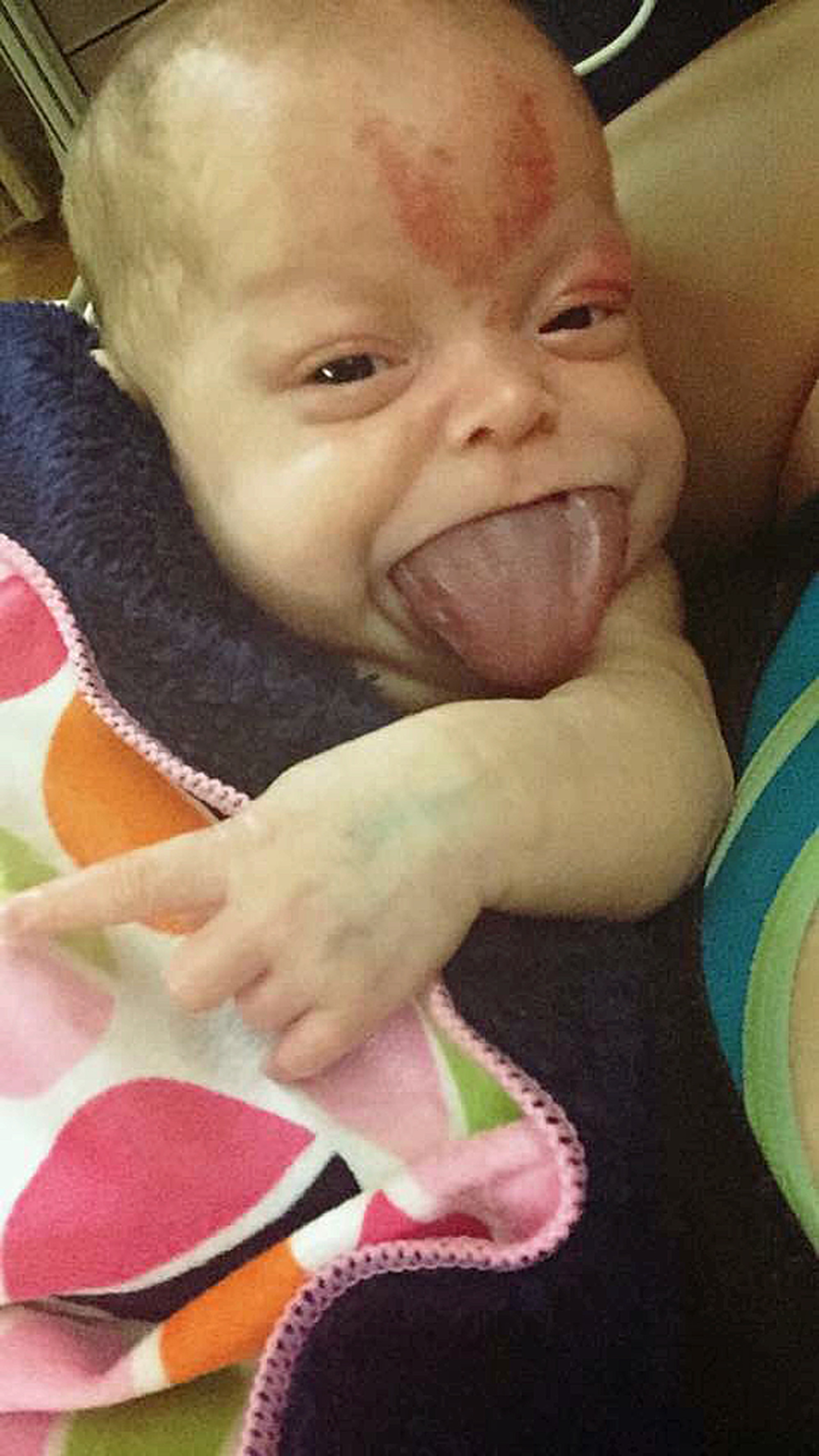 Baby born with big tongue: Photos | Kidspot