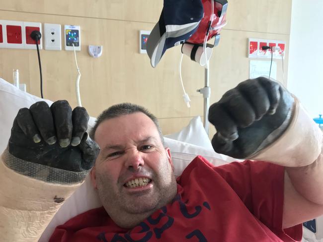 Jason 'Buddy' Miller of Queenscliff at Northern Beaches Hospital. As a result of sepsis he will lose both his hands and feet. Picture: Supplied.