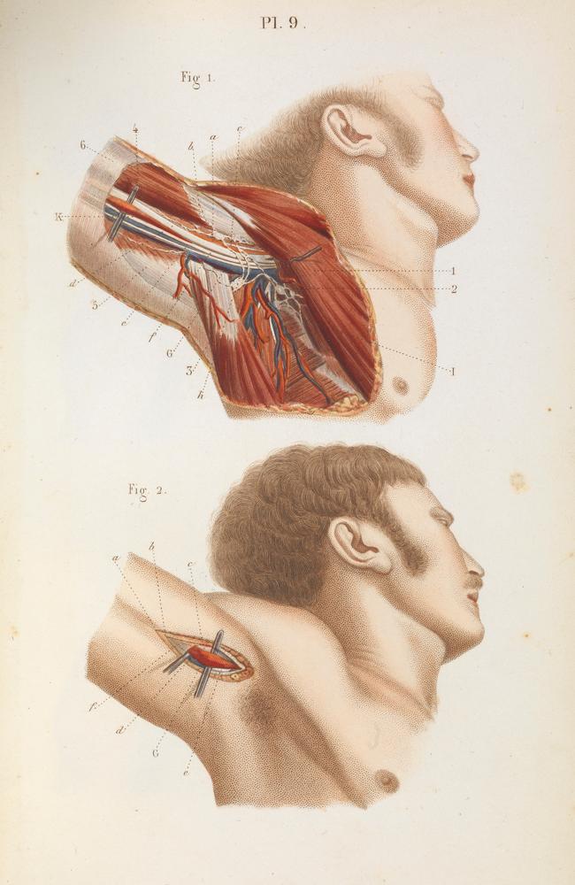 Ligature of the axillary artery in the armpit. Picture: Wellcome Library