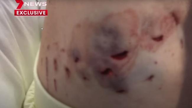 The shark bites on Michele Bootes body. Picture: 7News