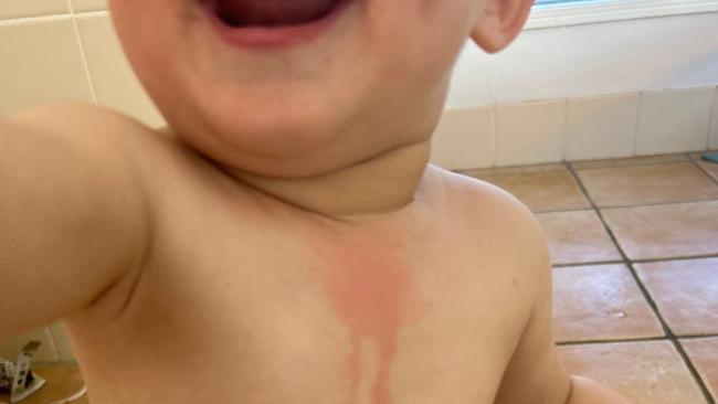 An urgent warning has been issued to parents after a toddler was burned by a lime when playing in a backyard pool. Credit: Instagram/ Tiny Hearts