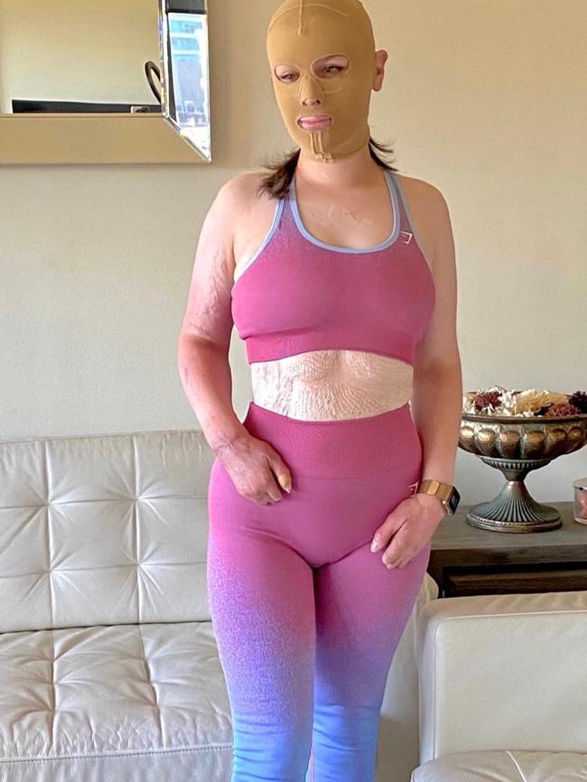 Stephanie has progressively removed bandages and compression garments, and revealed more of her body to her scores of social media followers. Source: Instagram