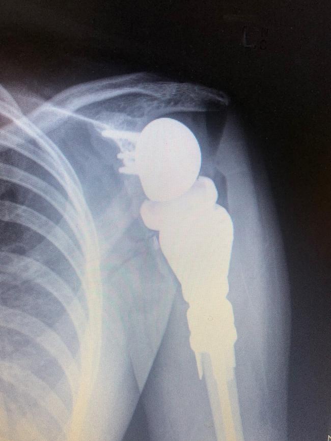 An X-ray of Charlotte Phillips’ shoulder after surgery to remove 10cm of her humerus and insert a titanium shoulder implant