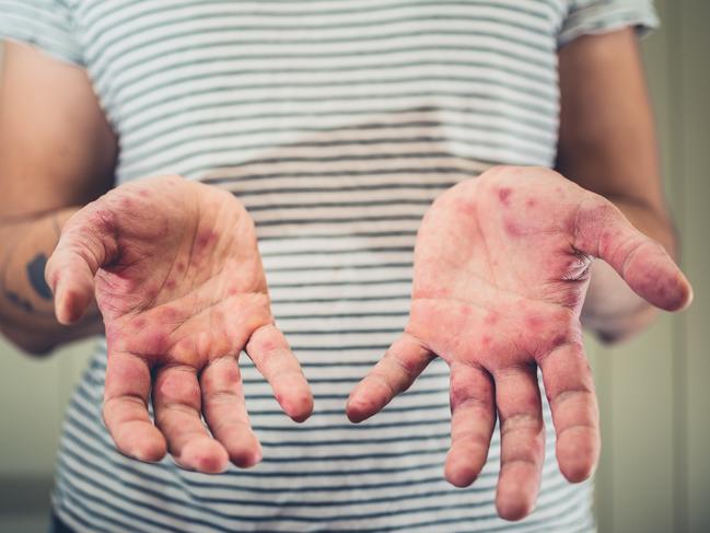 Measles, hand foot and mouth disease, istock