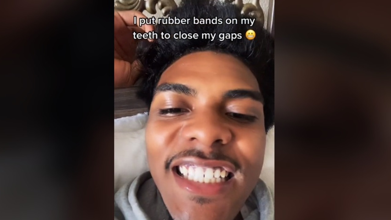 Dental surgeon takes aim at TikTok teeth hacks | news.com.au ...