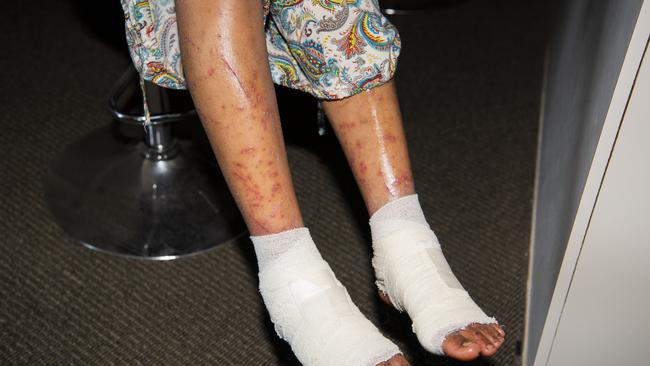 The injured legs of Yang Chen after her five days in Gold Coast bushland.