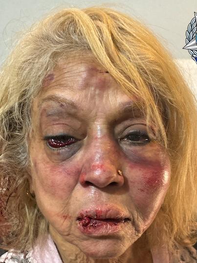 Ninette Simons received severe facial bruising and swelling after she was assaulted during a shocking home invasion at her Girrawheen home earlier this month. Credit: WA Police/Supplied