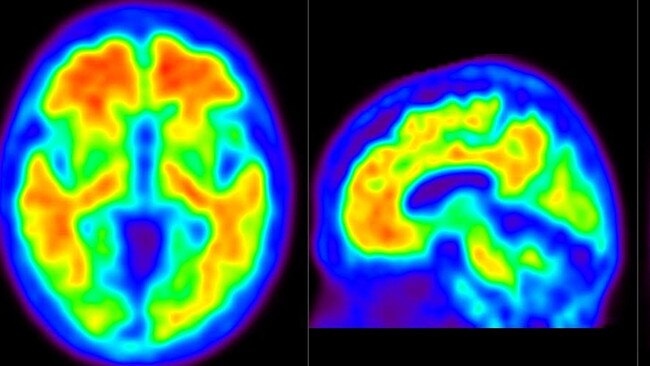A brain scan showing amyloid plaque in the brain of a person with Alzheimer's disease. Picture: Supplied