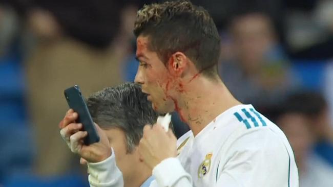 Cristiano Ronaldo assesses his injury.