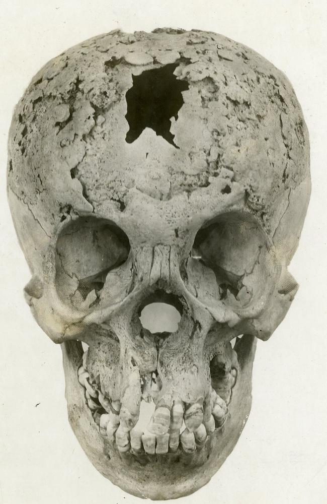Syphilis of skull. Picture: Otis Historical Archives Nat'l Museum of Health &amp; Medicine