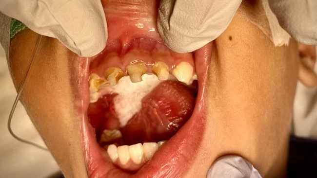 An unidentified young oral health patient from Far North Queensland who recently required surgery due to tooth decay. Picture: Supplied