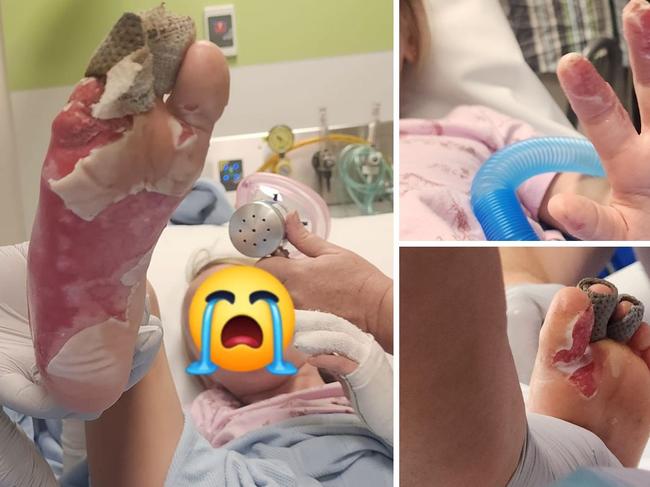 A seven-year-old girl left with third-degree burns to her feet and hands after stepping on a hidden campfire buried under sand at Keelbottom Creek near Mingela on Sunday. Picture: Facebook/Ashlea Hodder