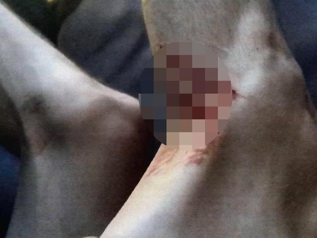 Stab wounds suffered by Jack Brearley, 23, who is one of four people accused of murdering Cassius Turvey. Mr Brearley alleges he received stab wounds from Cassius Turvey before the schoolboy was fatally struck by co-accused Brodie Palmer, an allegation Palmer denies. Picture: WA Police,