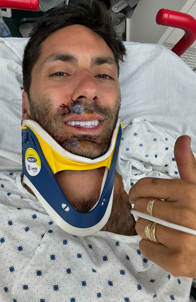 TV star Nev Schulman is lucky to be alive after a horror bike accident.