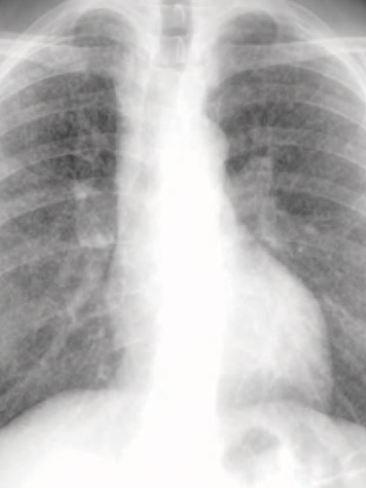 An xray of uncomplicated silicosis in the lungs.