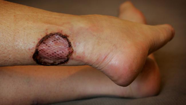A woman got the Bairnsdale Ulcer on her ankle.