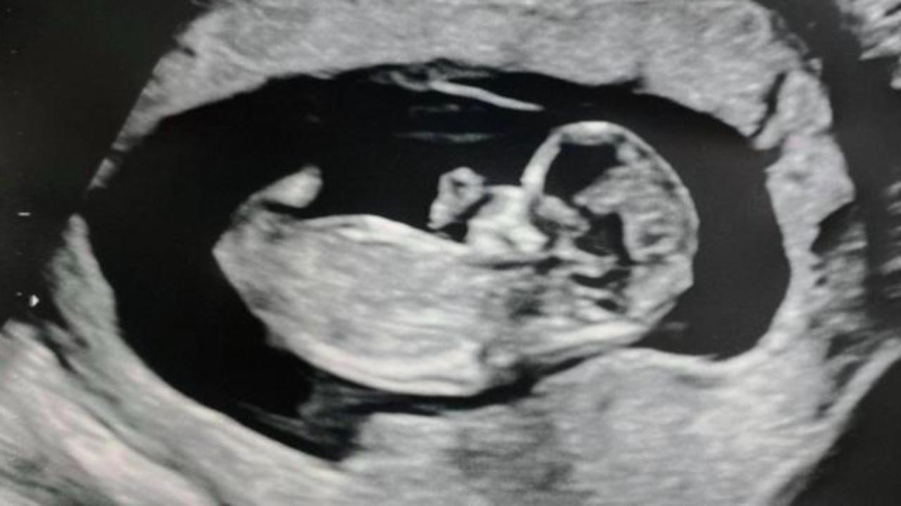 It was at her 19-week scan, Ms Faith said, that the doctors saw ‘something … that would end up changing our lives forever’. Picture: Supplied