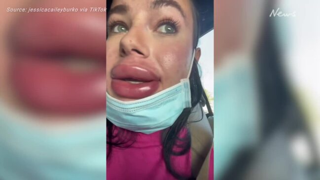 Botched Cosmetic Procedures Jessica Burkos Lip Filler Injection Explodes Au 
