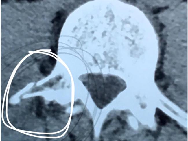 The x-ray of Mike Baird’s fractured vertebrae. Picture: Facebook