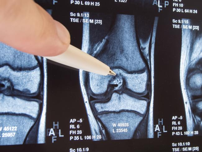 Knee joint x-ray or MRI. Doctor pointed on area of knee joint, where pathology or problem is detected, such fracture, destruction of joint, osteoarthritis. Diagnosis of knee diseases by radiology.  Picture: istock