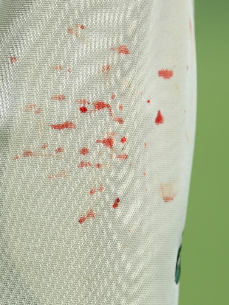 Blood stains on Mitch Starc’s pants.